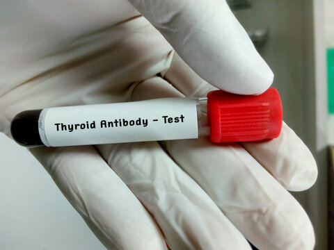 Blood sample in test tube for hormonal examination of thyroid gland in laboratory. Anti microsomal, anti thyroglobulin, TSH. Diagnosis of thyroid cancer