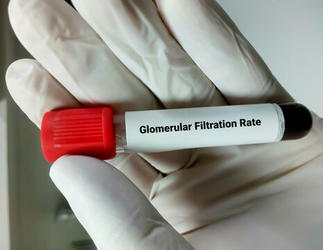 Blood sample for Renal Function Test. GFR, eGFR, Creatinine, Bun. Closeup.
