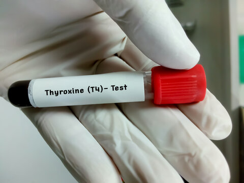 Blood sample in test tubes for hormonal examination of thyroid gland in laboratory. Total T4, Diagnosis of hyperthyroidism or hypothyroidism of a patient