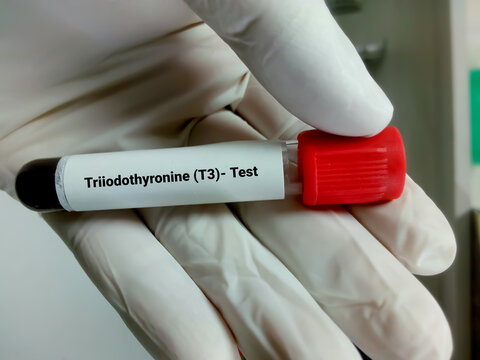 Blood sample in test tubes for hormonal examination of thyroid gland in laboratory. Total T3, Diagnosis of hyperthyroidism or hypothyroidism of a patient