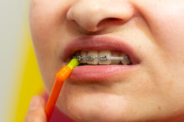 Girl with dental braces and brackets holding toothbrush for dental hygiene
