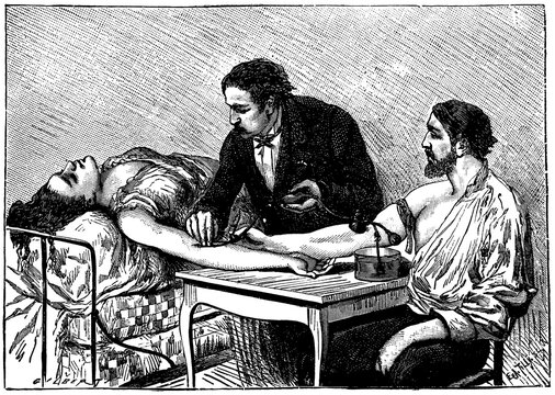 Drainage of blood or transfusion. Illustration of the 19th century. Germany. White background.