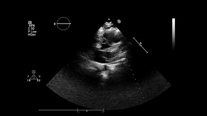 Image of the heart in gray-scale mode during transesophageal ultrasound.