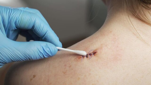 Scar from surgery. Wound scar.The scar on the shoulder.Scar with thread.