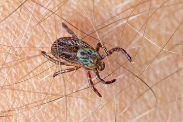 Lyme disease-carrier Ixodes tick Dermacentor marginatus on human skin.
