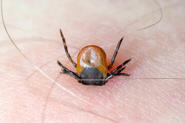 Tick with its chelicerae sticking in human skin.