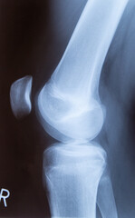 Röntgenbild, Röntgenaufnahme  von gestrecktem Knie / Kniegelenk.