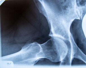 Röntegenbild, Röntgenaufnahme  von Kugelgelenk / Hüfte.