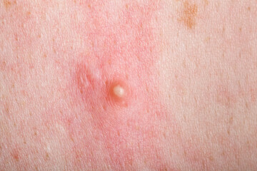 Fototapeta premium ripe pimple on the inflamed reddened skin of a person close-up, problem dry skin with an inflammatory rash.