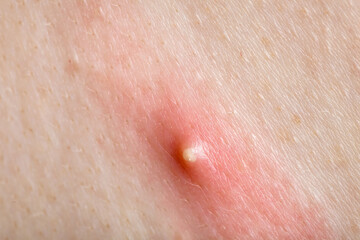 Fototapeta premium purulent pimple on inflamed human skin close-up, teen body health and problems.