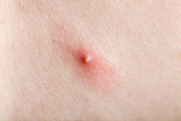 Fototapeta premium inflamed purulent pimple with pus on human body skin close-up, health care dermatology.