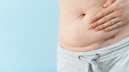 Closeup of woman belly with a scar from a cesarean section on blue background.