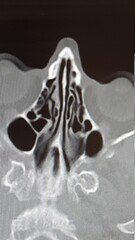CT scan of the ethmoid sinus air cells