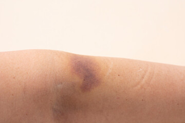 a large hematoma on a woman's arm after injections in the treatment of covid.