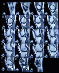 Magnetresonanztomographie / MRT von einem Knie / Kniegelenk.