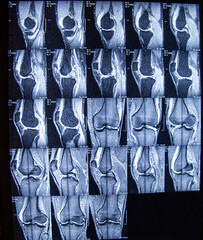 Magnetresonanztomographie / MRT von einem Knie / Kniegelenk.