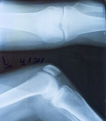 Röntgenbild, Röntgenaufnahme  von einem Knie / Kniegelenk, gestreckt und gebeugt.