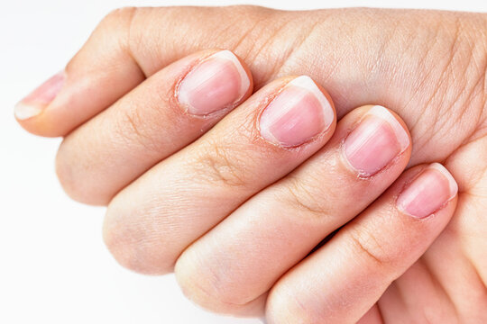 Close up on a female hands with dry skin and hangnails. Long fingernails and cuticles in bad condition. Chapped and neglected hands. Hands care concept. Lack of manicure in a lady fingers.
