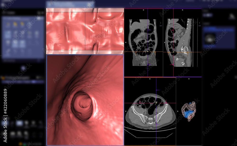 Aufkleber ct colonography or ct scan of colon axial view vs coronal view and 3d rendering image on the screen 
