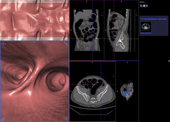 CT colonography or CT Scan of Colon axial view vs Coronal view and 3D rendering image