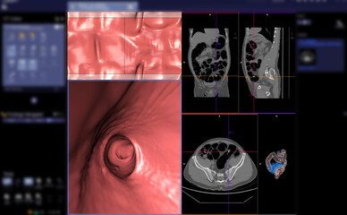 CT colonography or CT Scan of Colon axial view vs Coronal view and 3D rendering image on the screen...