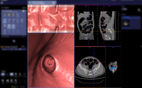 CT colonography or CT Scan of Colon axial view vs Coronal view and 3D rendering image on the screen for diagnosis large bowel cancer.