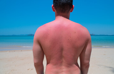 skin at the back of young man get sunburn after swimming in the sea at sunny day in summer