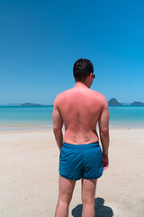 skin at the back of young man get sunburn after swimming in the sea at sunny day in summer