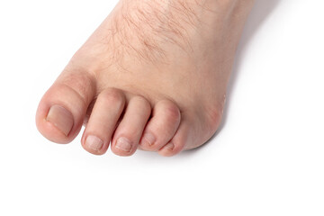 studio lighting. a human leg on a white background. The finger is strongly curved, deformed. Close-up.