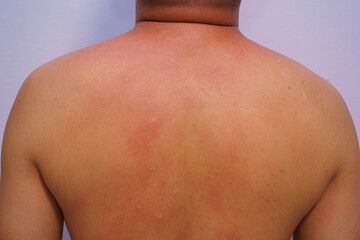 Man adult onset food allergy have had a severe reaction emergency care confirmed diagnosis Itchy...