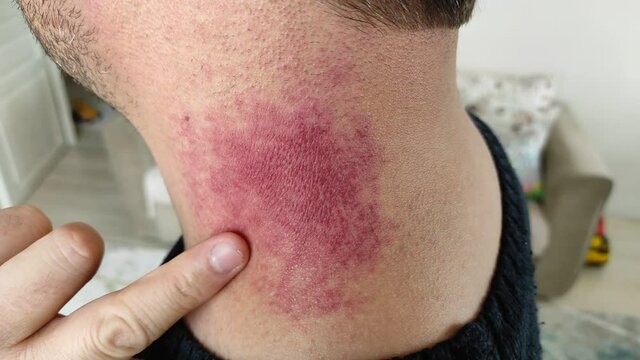 neck injury, neck rash, bruising in the neck area,