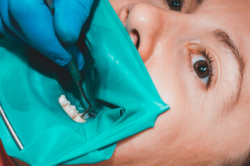 treatment of a chewing tooth, the dentist put a rubber dam, uses sterile tools, uses modern technology.