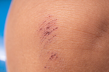 Fototapeta premium close up of little scab wound on kid's knee