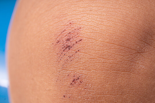 close up of little scab wound on kid's knee
