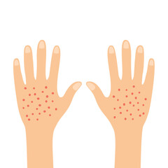 Red rash on back female hands skin in flat design on white background. Itching and irritation symptom. 