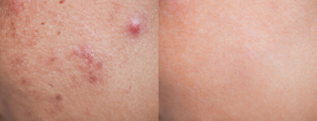 Closeup skin face texture before and afer facial treatment problem of spot  scar acne .Problem...