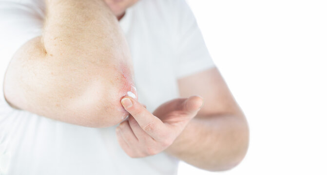 One man applies a cream to an elbow affected by psoriasis. The concept of skin care.