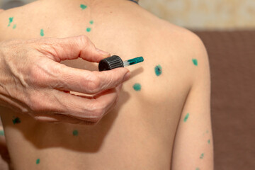 Obraz na płótnie Canvas A woman applies an antiseptic to a rash of a chickenpox broker at home. Selective focus.
