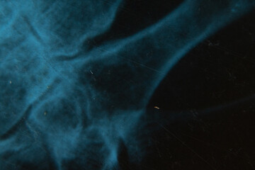 X-ray of an elderly person with osteoporosis and arthritis arthrosis, bone destruction