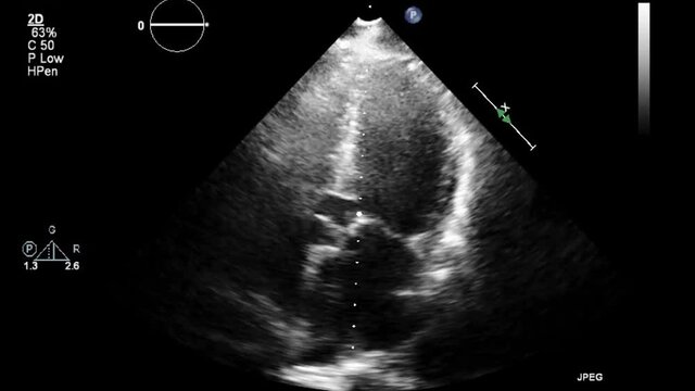 Transesophageal ultrasound video in gray-scale mode.
