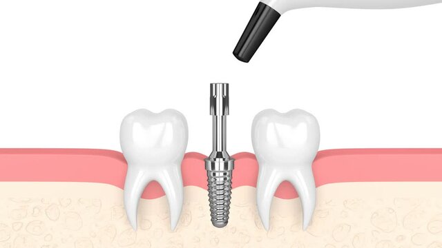 Checking dental implant stability by osseointegration monitoring device