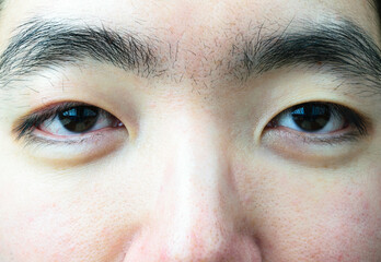 Fototapeta premium Illness Asian male human eye
