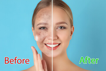 Young woman before and after cosmetic procedure on light blue background