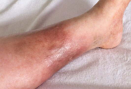 A woman's leg is shown, she is suffering from Chronic Venous Insufficiency with mild cellulitis in her legs. In bed as she rest to relieve heaviness, swelling, pain  redness in the leg. Top shot