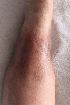 Top view of a woman's leg is shown, suffering from Chronic Venous Insufficiency with mild cellulitis in her legs. In bed as she rest to relieve heaviness, swelling, pain and redness in the leg. 
