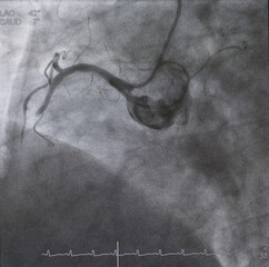 Coronary angiogram (CAG) was performed total occlusion at right coronary artery (RCA).