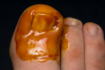 Fototapeta premium close-up photo of a toenail infection in human 