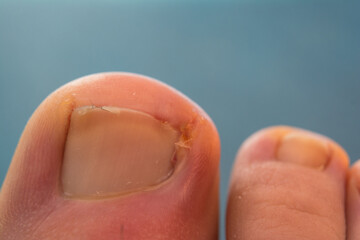 close-up photo of a toenail infection in human	