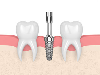 3d render of dental implant with multipeg to check implant stability