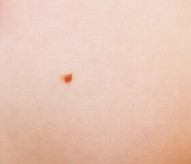 Fototapeta premium Mole on skin